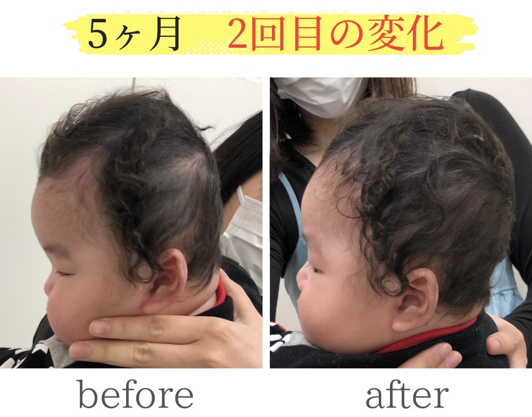 頭の変形ビフォーアフター