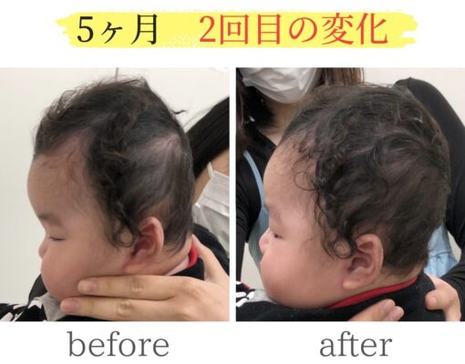 頭の変形ビフォーアフター