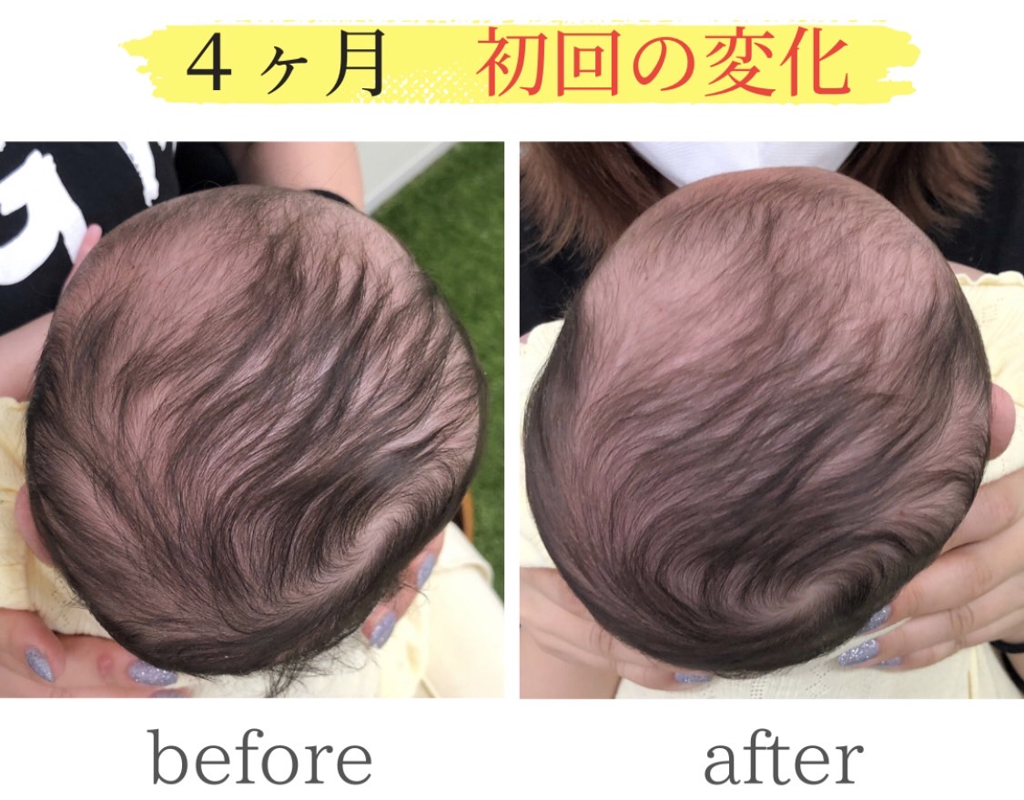 頭の変形ビフォーアフター