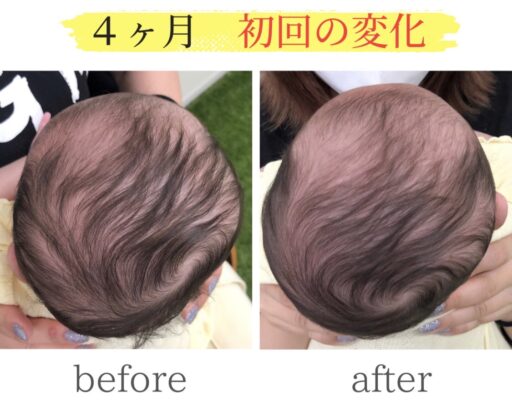 頭の変形ビフォーアフター
