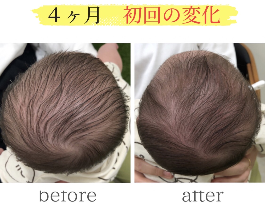 頭の変形ビフォーアフター