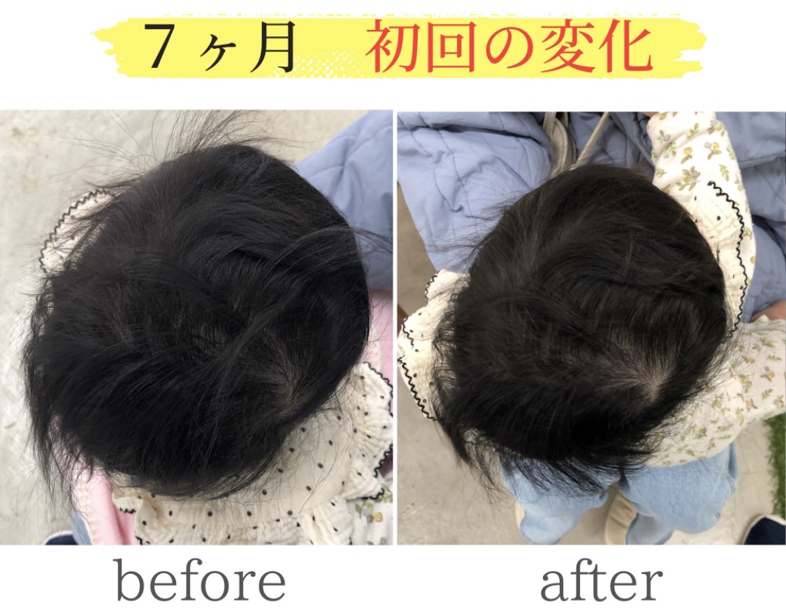 頭の変形ビフォーアフター