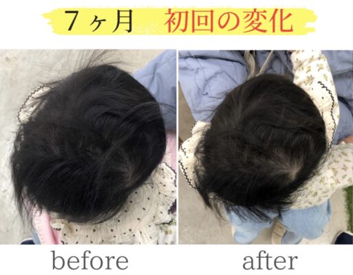 頭の変形ビフォーアフター