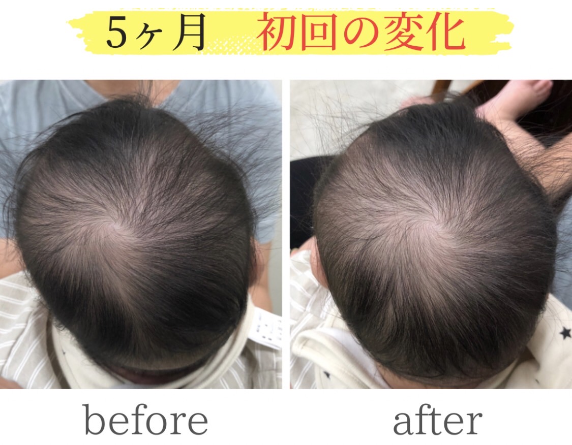 頭の変形ビフォーアフター